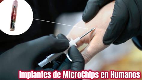 Microchips en humanos 